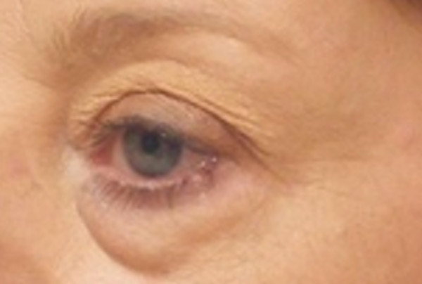 blefaroplastia inferior: bolsas de grasa en los ojos