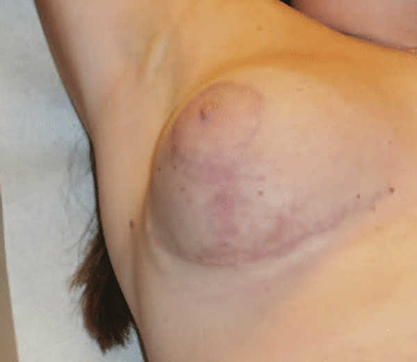 Evolución de las cicatrices de la reduccion mamaria